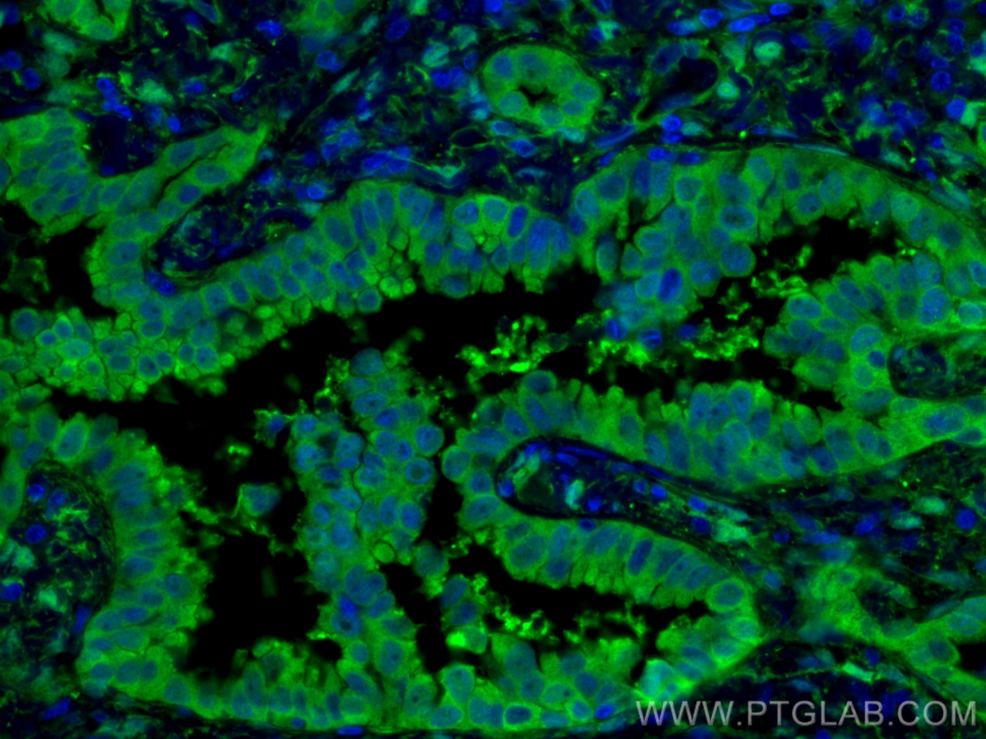 Immunofluorescence (IF) / fluorescent staining of human lung cancer tissue using YAP1 Polyclonal antibody (13584-1-AP)
