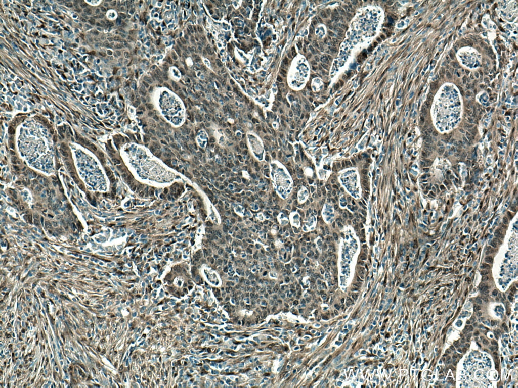 Immunohistochemistry (IHC) staining of human colon cancer tissue using YAP1 Polyclonal antibody (13584-1-AP)