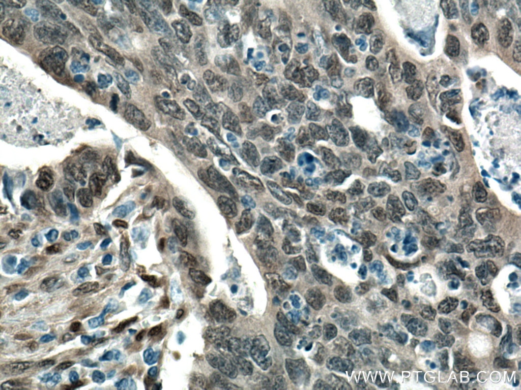 Immunohistochemistry (IHC) staining of human colon cancer tissue using YAP1 Polyclonal antibody (13584-1-AP)