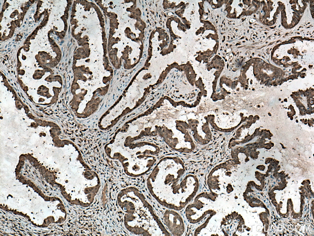 Immunohistochemistry (IHC) staining of human ovary tumor tissue using YAP1 Polyclonal antibody (13584-1-AP)