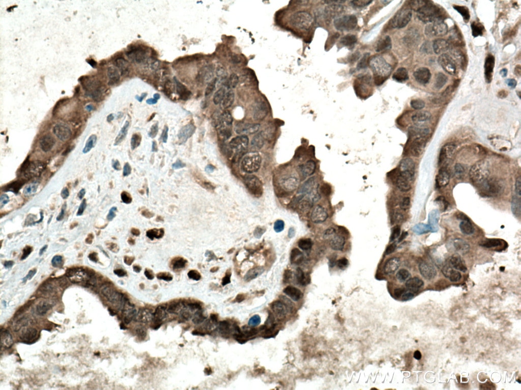 Immunohistochemistry (IHC) staining of human ovary tumor tissue using YAP1 Polyclonal antibody (13584-1-AP)