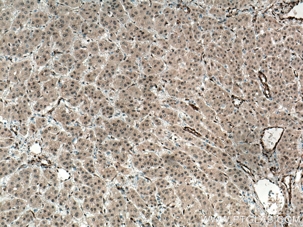 Immunohistochemistry (IHC) staining of human liver cancer tissue using YAP1 Polyclonal antibody (13584-1-AP)