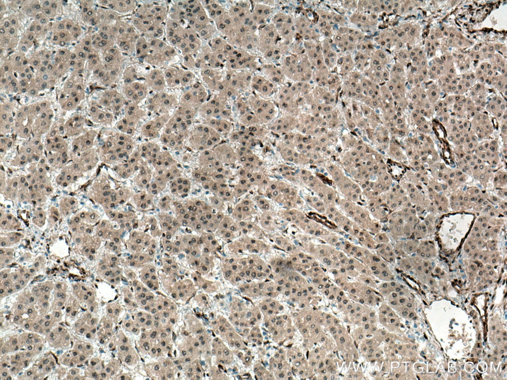 IHC staining of human liver cancer using 13584-1-AP