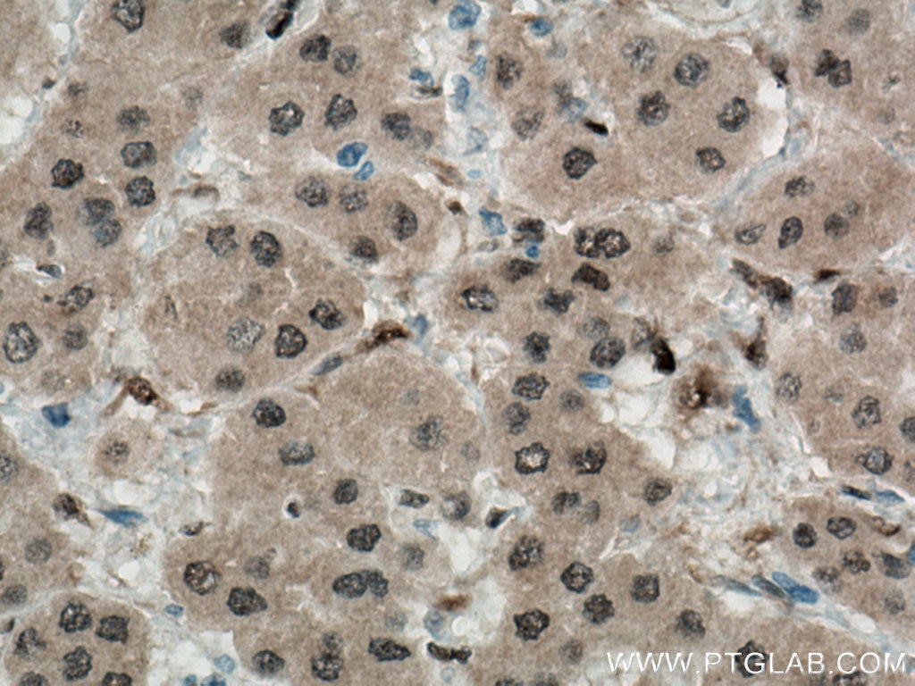 Immunohistochemistry (IHC) staining of human liver cancer tissue using YAP1 Polyclonal antibody (13584-1-AP)