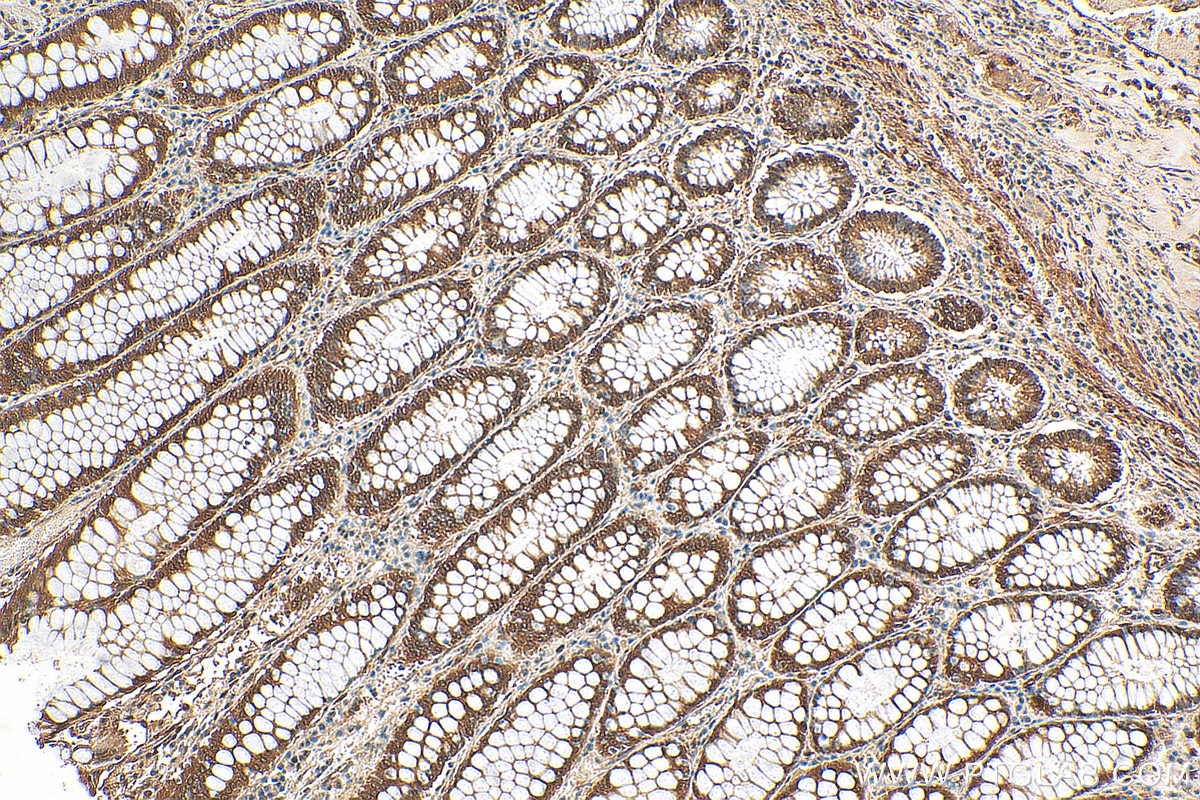 Immunohistochemistry (IHC) staining of human colon cancer tissue using YAP1 Polyclonal antibody (13584-1-AP)