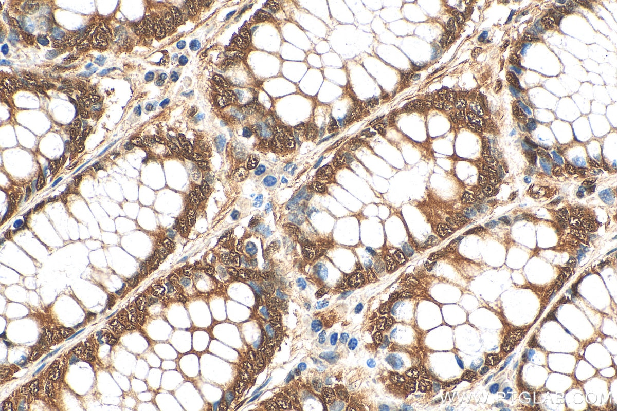 Immunohistochemistry (IHC) staining of human colon cancer tissue using YAP1 Polyclonal antibody (13584-1-AP)