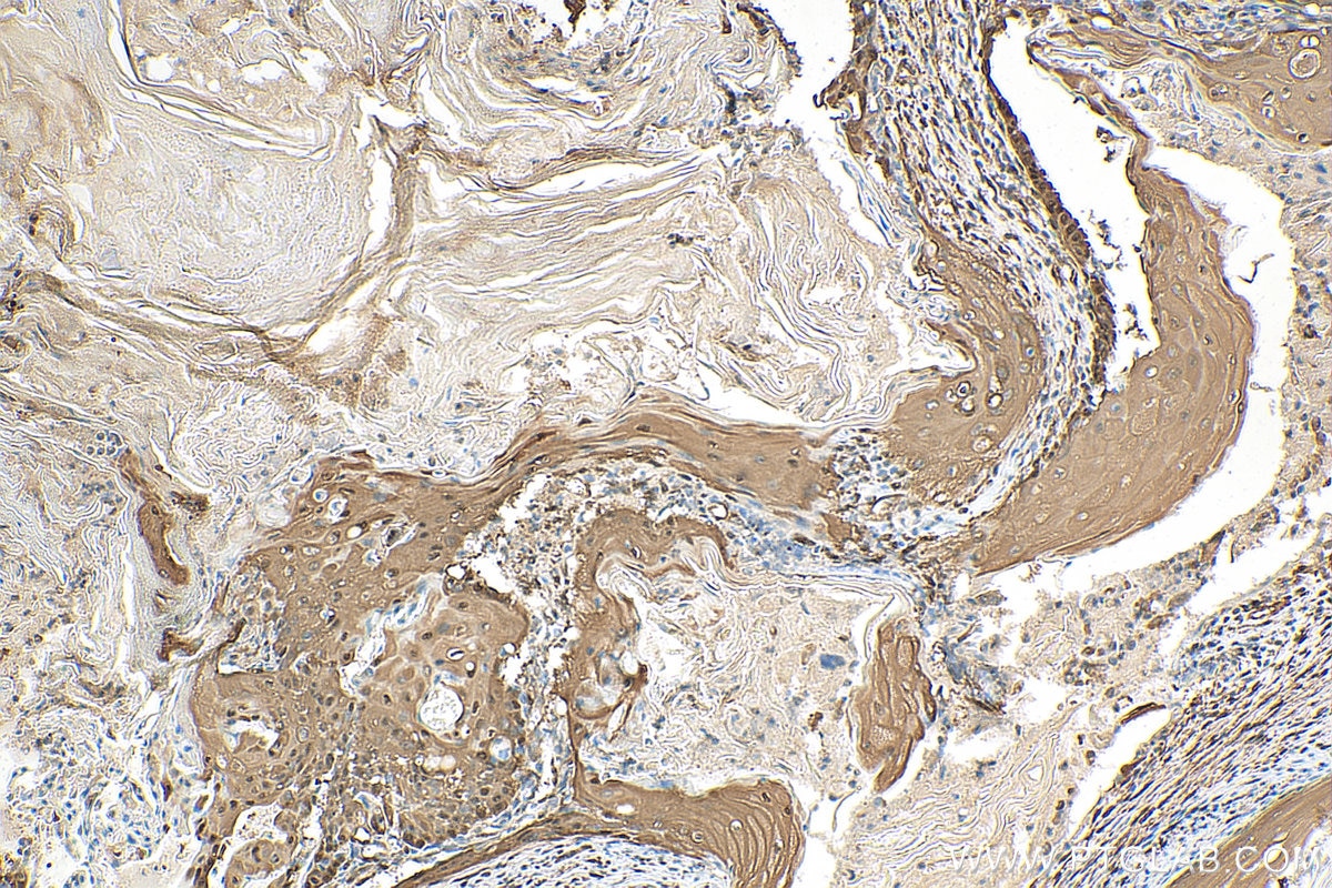 IHC staining of human ovary tumor using 13584-1-AP