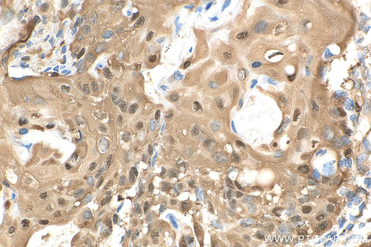 Immunohistochemistry (IHC) staining of human ovary tumor tissue using YAP1 Polyclonal antibody (13584-1-AP)