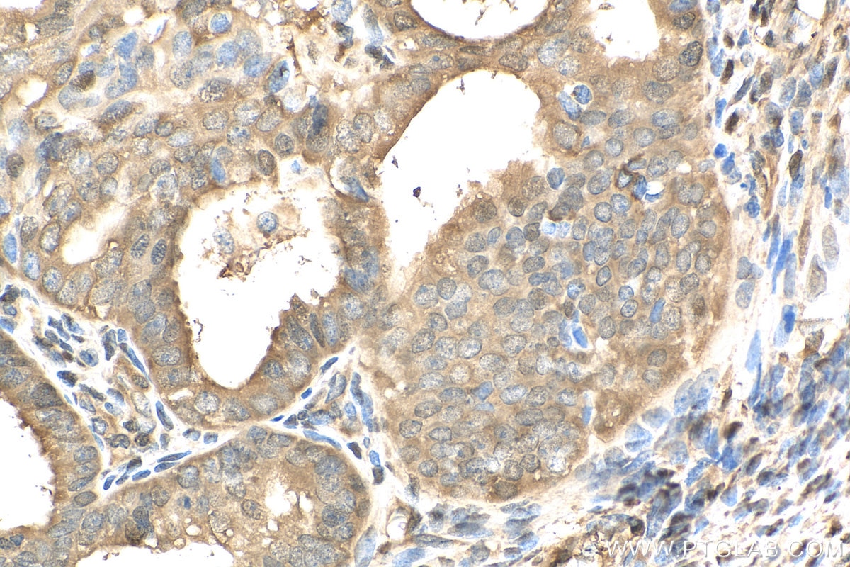 Immunohistochemistry (IHC) staining of human ovary tumor tissue using YAP1 Polyclonal antibody (13584-1-AP)