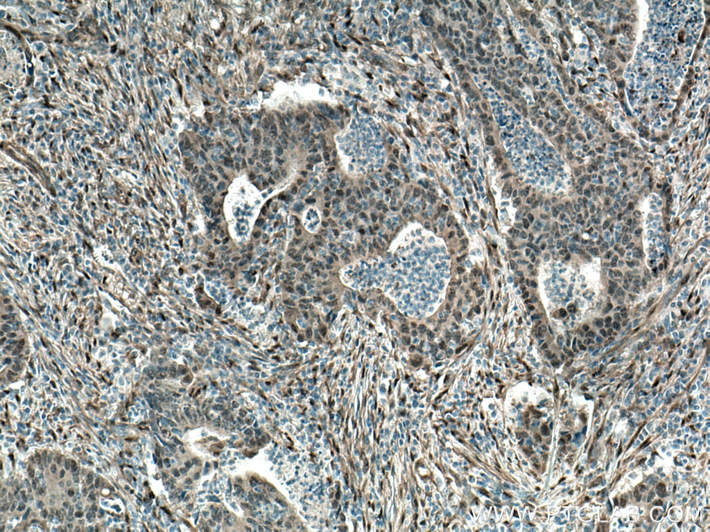 Immunohistochemistry (IHC) staining of human colon cancer tissue using YAP1 Monoclonal antibody (66900-1-Ig)