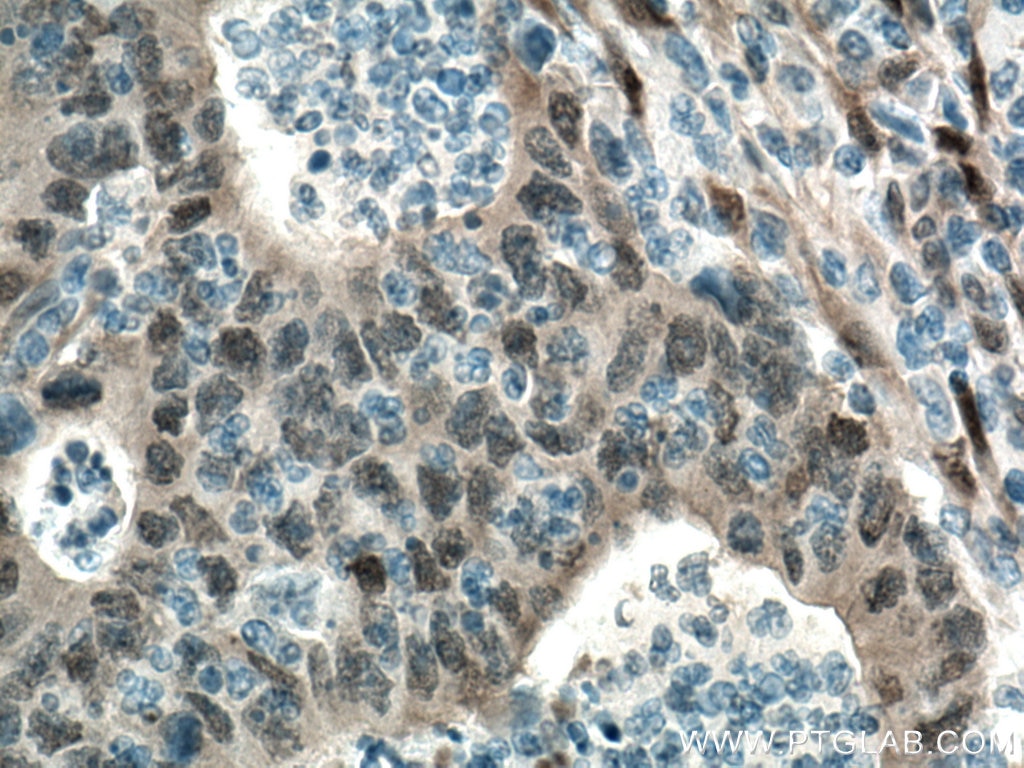 Immunohistochemistry (IHC) staining of human colon cancer tissue using YAP1 Monoclonal antibody (66900-1-Ig)