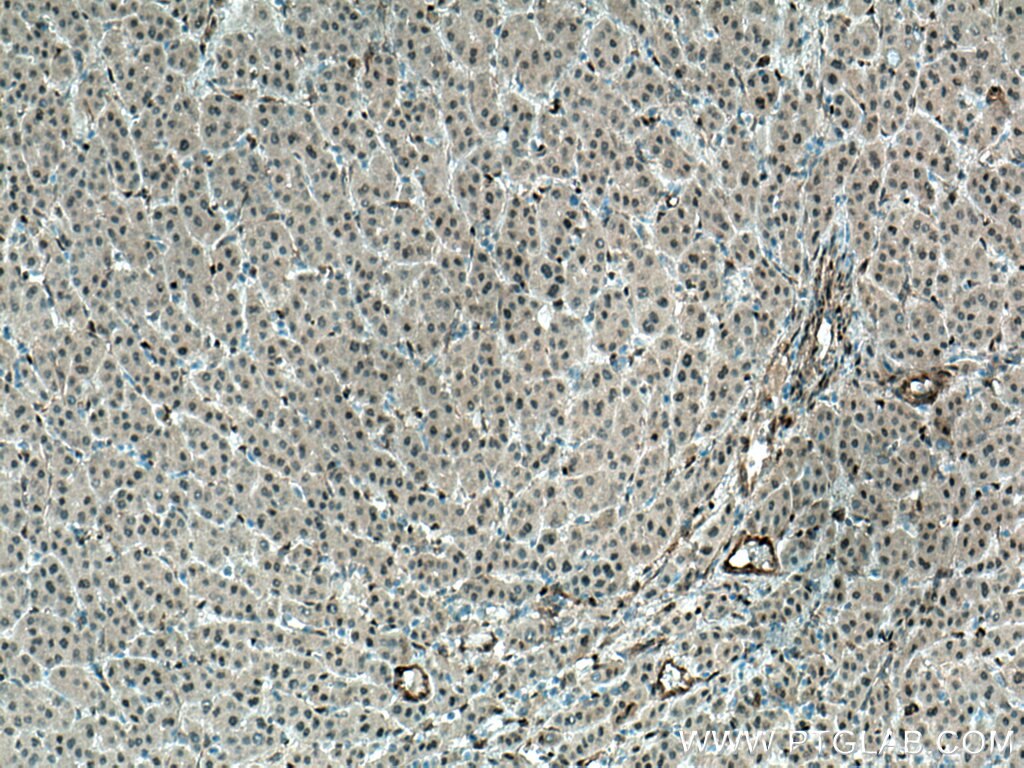 IHC staining of human liver cancer using 66900-1-Ig