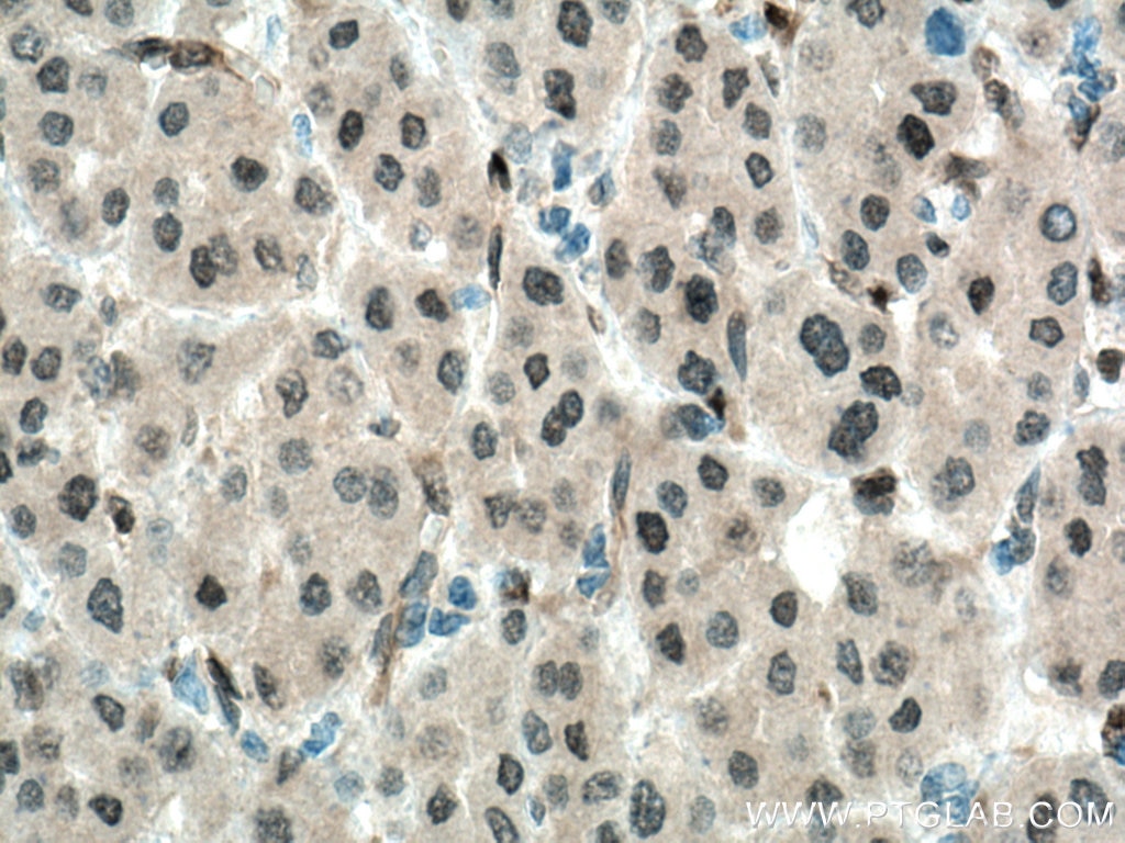 Immunohistochemistry (IHC) staining of human liver cancer tissue using YAP1 Monoclonal antibody (66900-1-Ig)