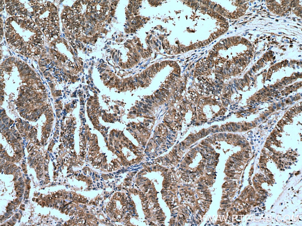 Immunohistochemistry (IHC) staining of human ovary tumor tissue using YAP1 Monoclonal antibody (66900-1-Ig)