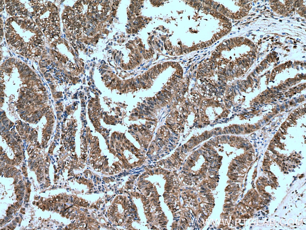 IHC staining of human ovary tumor using 66900-1-Ig