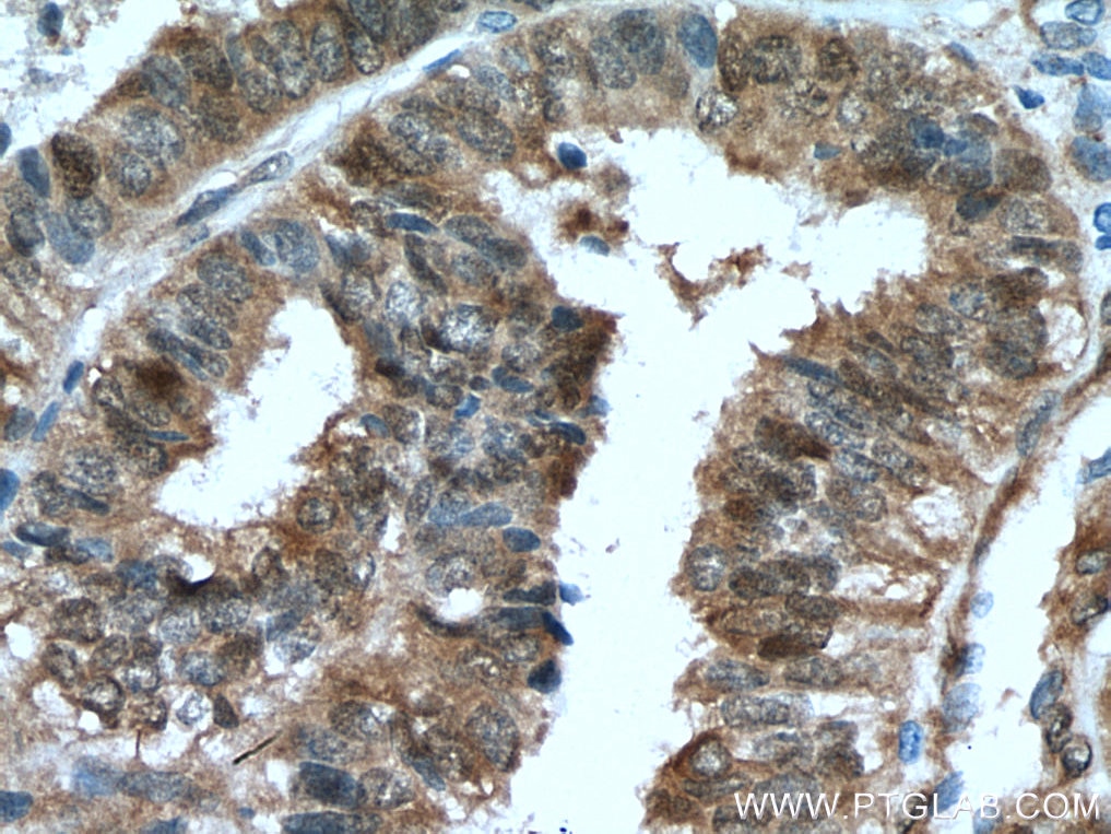 Immunohistochemistry (IHC) staining of human ovary tumor tissue using YAP1 Monoclonal antibody (66900-1-Ig)