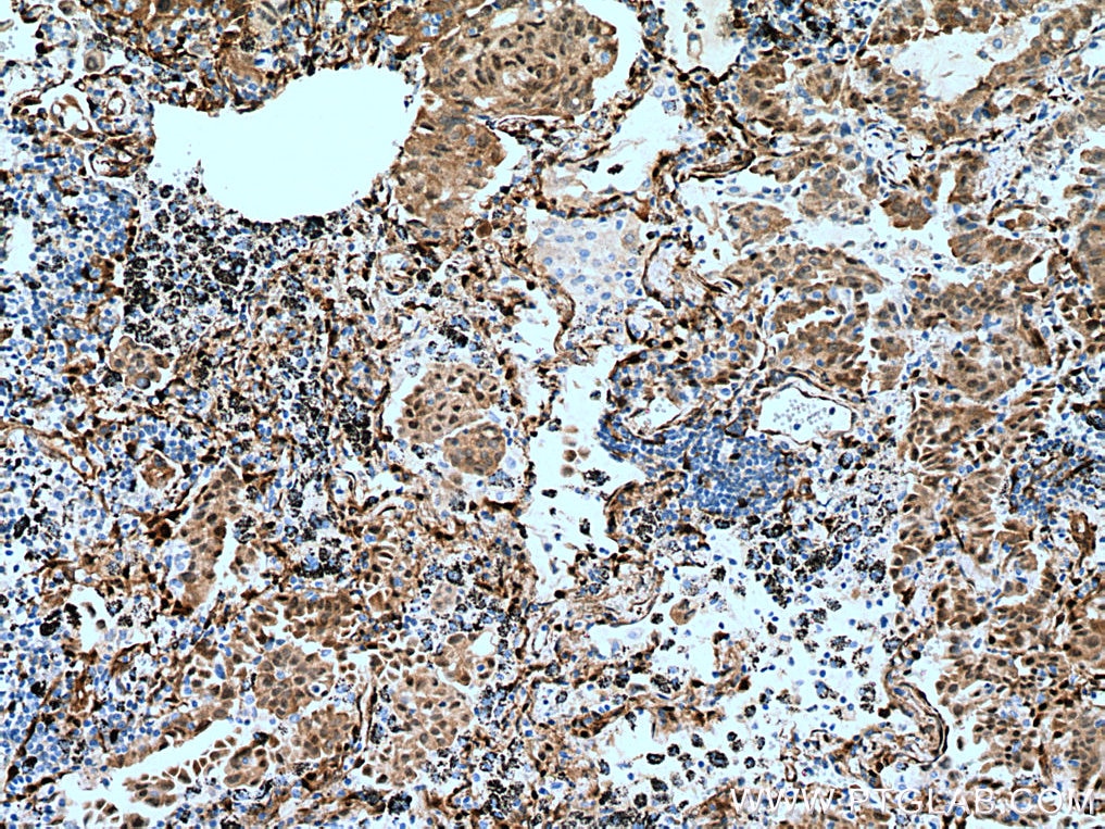 Immunohistochemistry (IHC) staining of human lung cancer tissue using YAP1 Monoclonal antibody (66900-1-Ig)