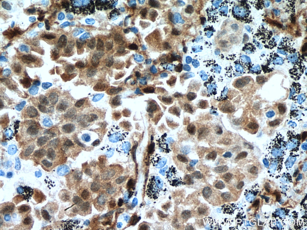 Immunohistochemistry (IHC) staining of human lung cancer tissue using YAP1 Monoclonal antibody (66900-1-Ig)