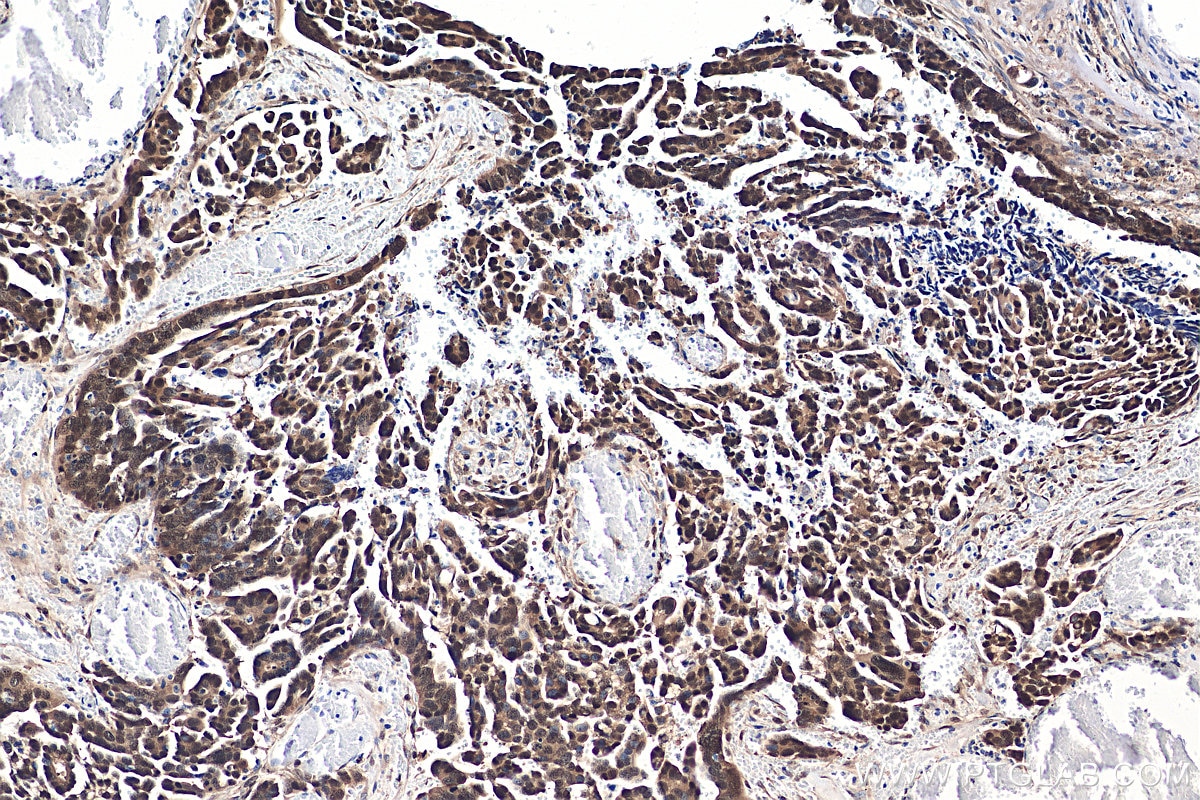 Immunohistochemistry (IHC) staining of human colon cancer tissue using YAP1 Recombinant antibody (81090-1-RR)