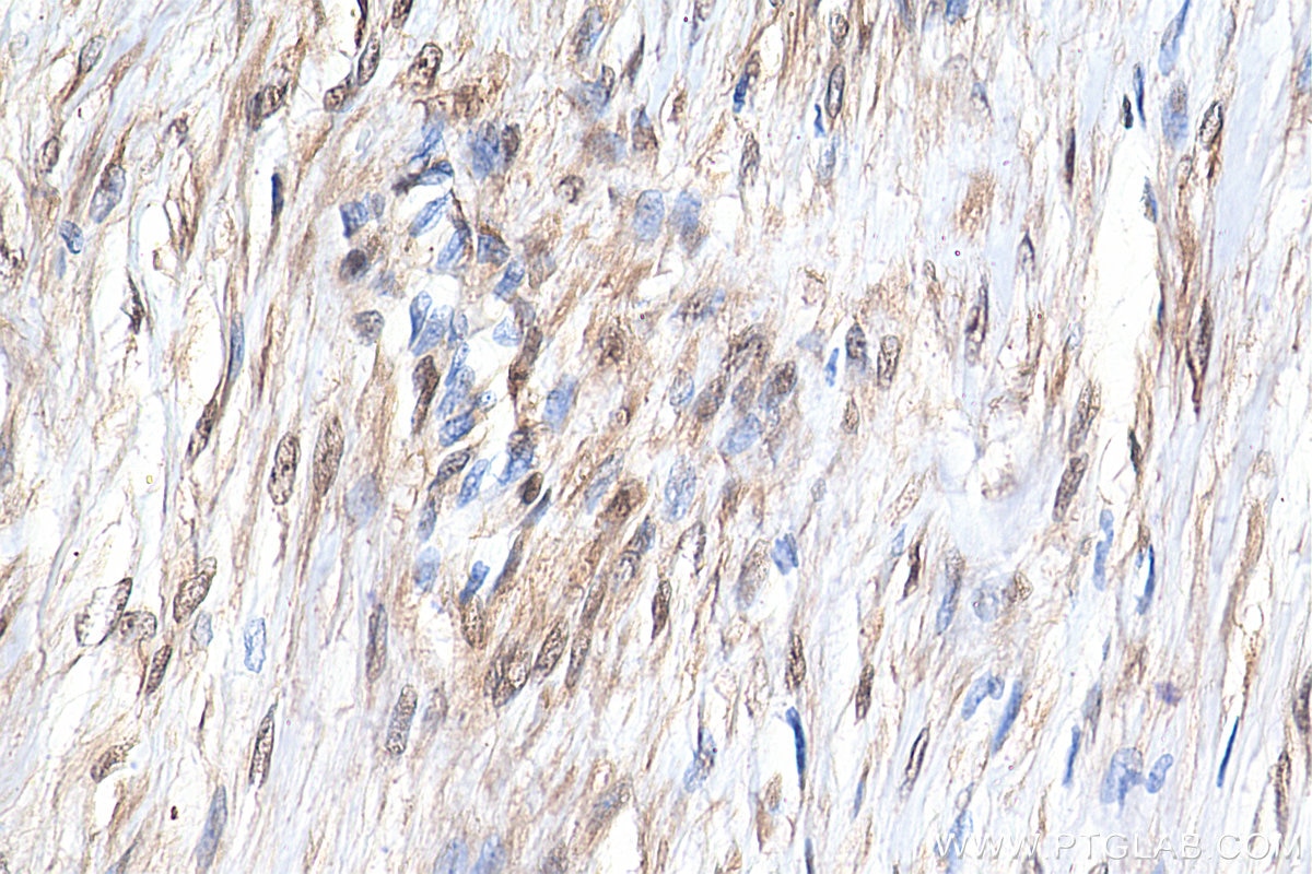 Immunohistochemistry (IHC) staining of human colon cancer tissue using YAP1 Recombinant antibody (81090-1-RR)