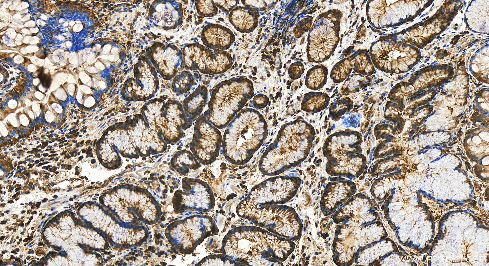 Immunohistochemistry (IHC) staining of human stomach cancer tissue using YARS Polyclonal antibody (31228-1-AP)
