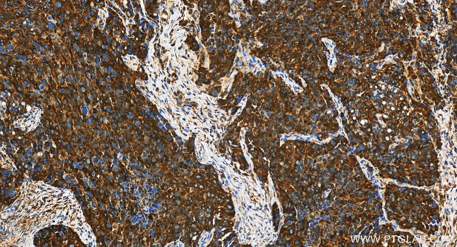 Immunohistochemistry (IHC) staining of human ovary cancer tissue using YARS Polyclonal antibody (31228-1-AP)