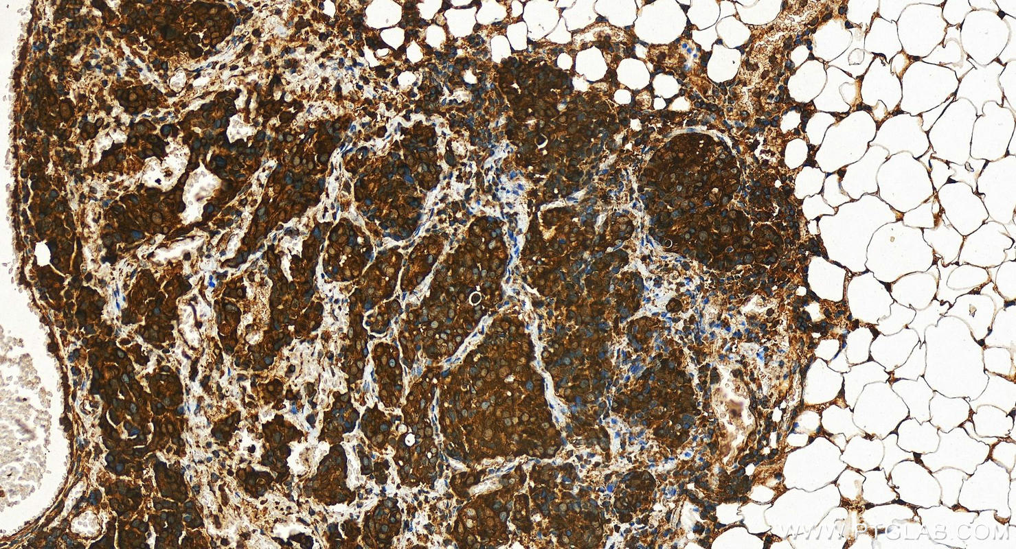 Immunohistochemistry (IHC) staining of human ovary cancer tissue using YARS Polyclonal antibody (31228-1-AP)