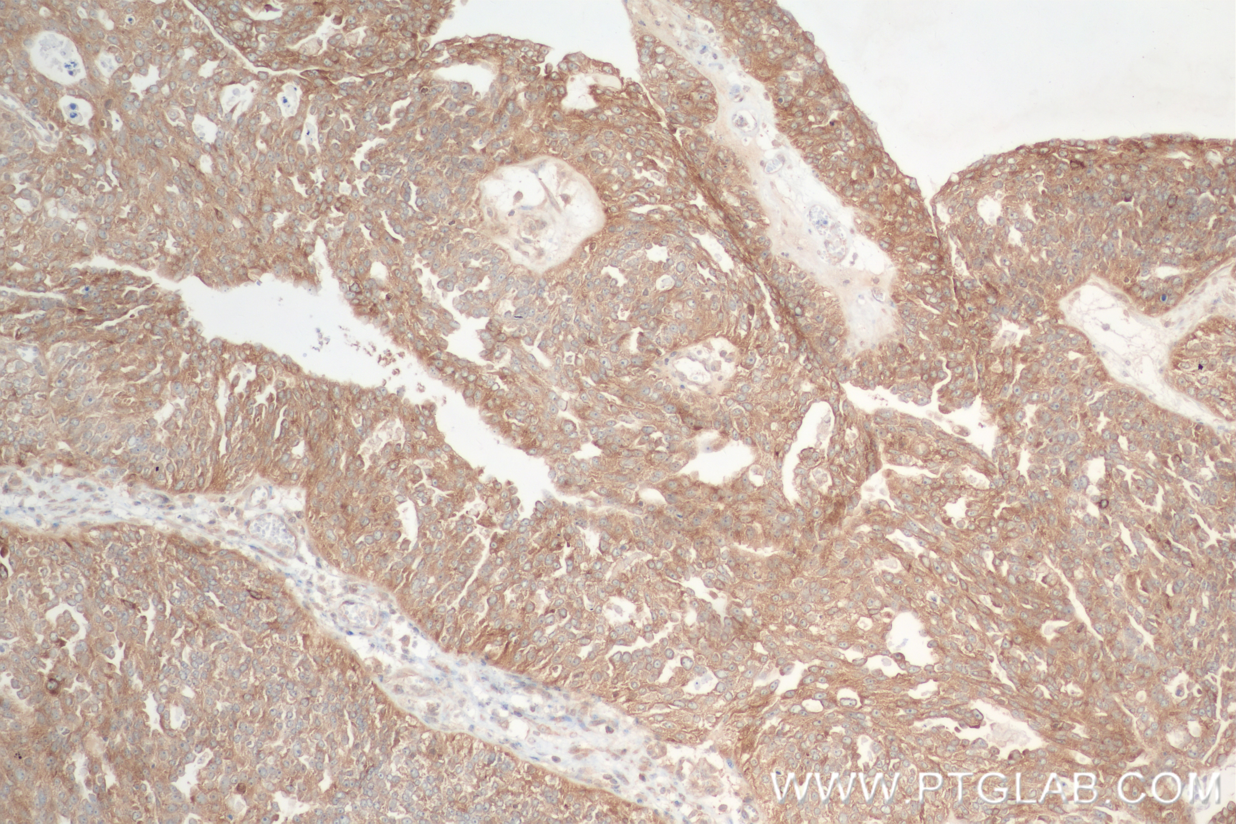 Immunohistochemistry (IHC) staining of human ovary cancer tissue using YARS Recombinant antibody (84859-3-RR)