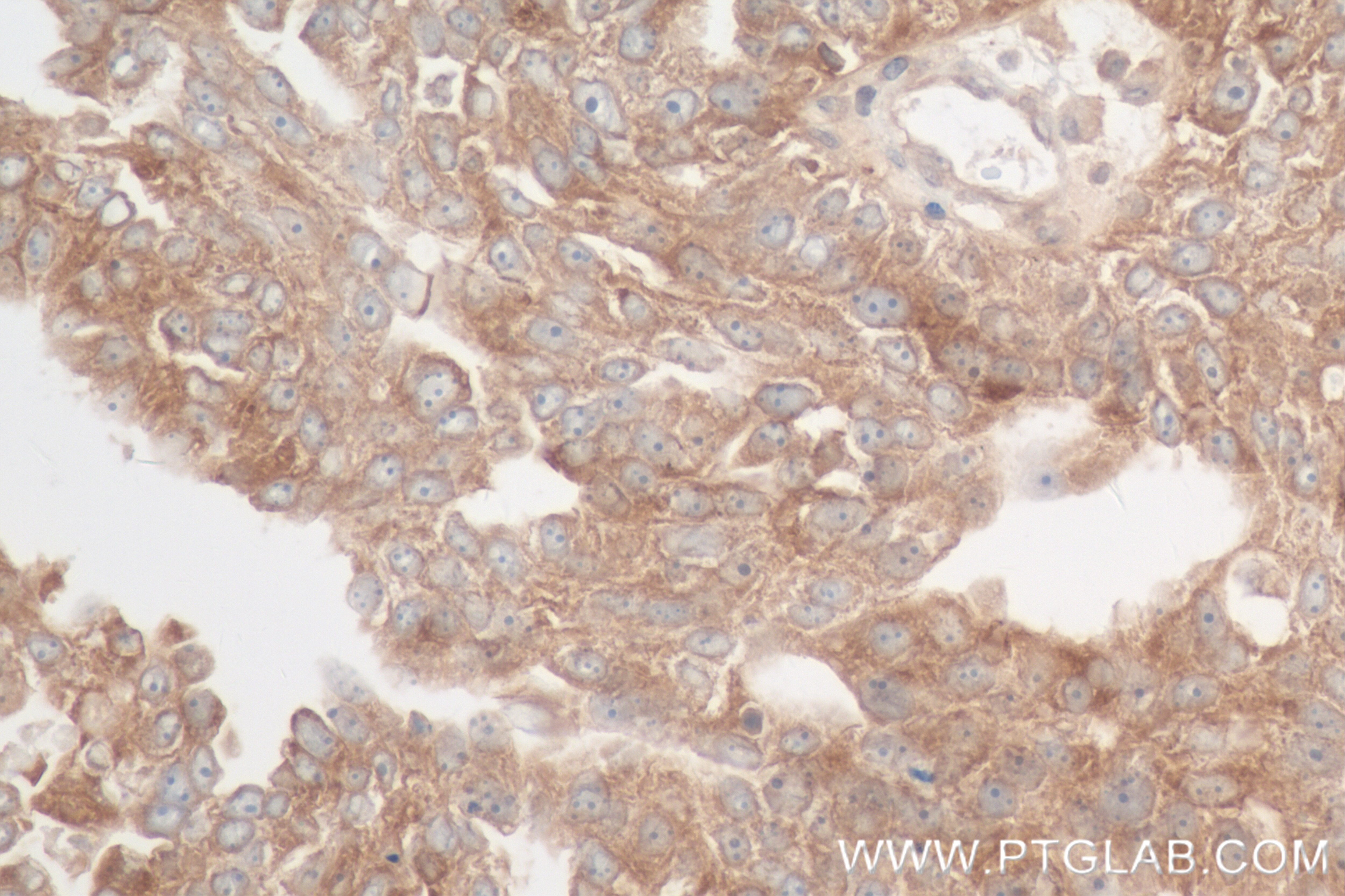 Immunohistochemistry (IHC) staining of human ovary cancer tissue using YARS Recombinant antibody (84859-3-RR)