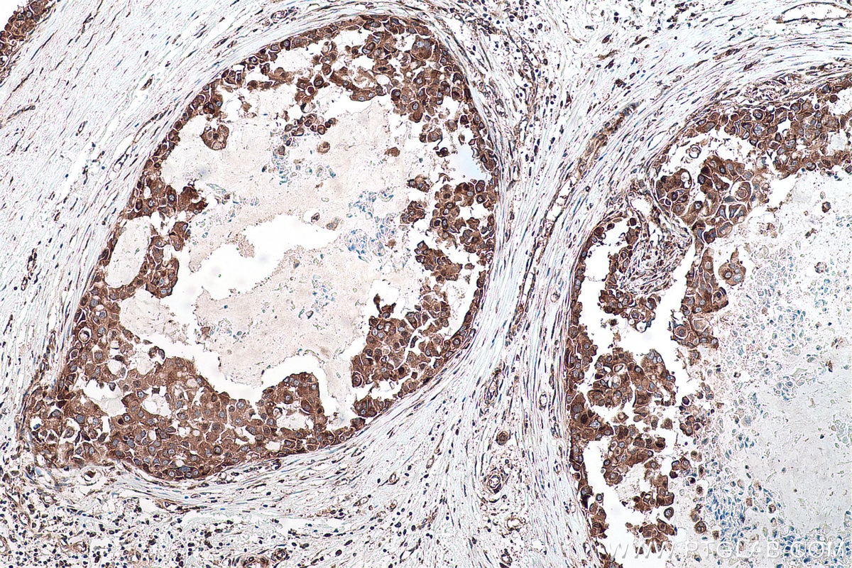 Immunohistochemistry (IHC) staining of human breast cancer tissue using YBX1 Polyclonal antibody (20339-1-AP)