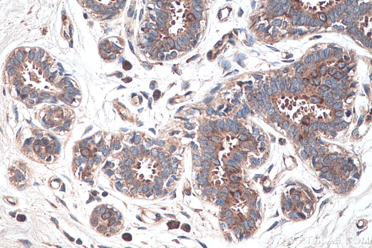 Immunohistochemistry (IHC) staining of human breast cancer tissue using YBX1 Polyclonal antibody (20339-1-AP)