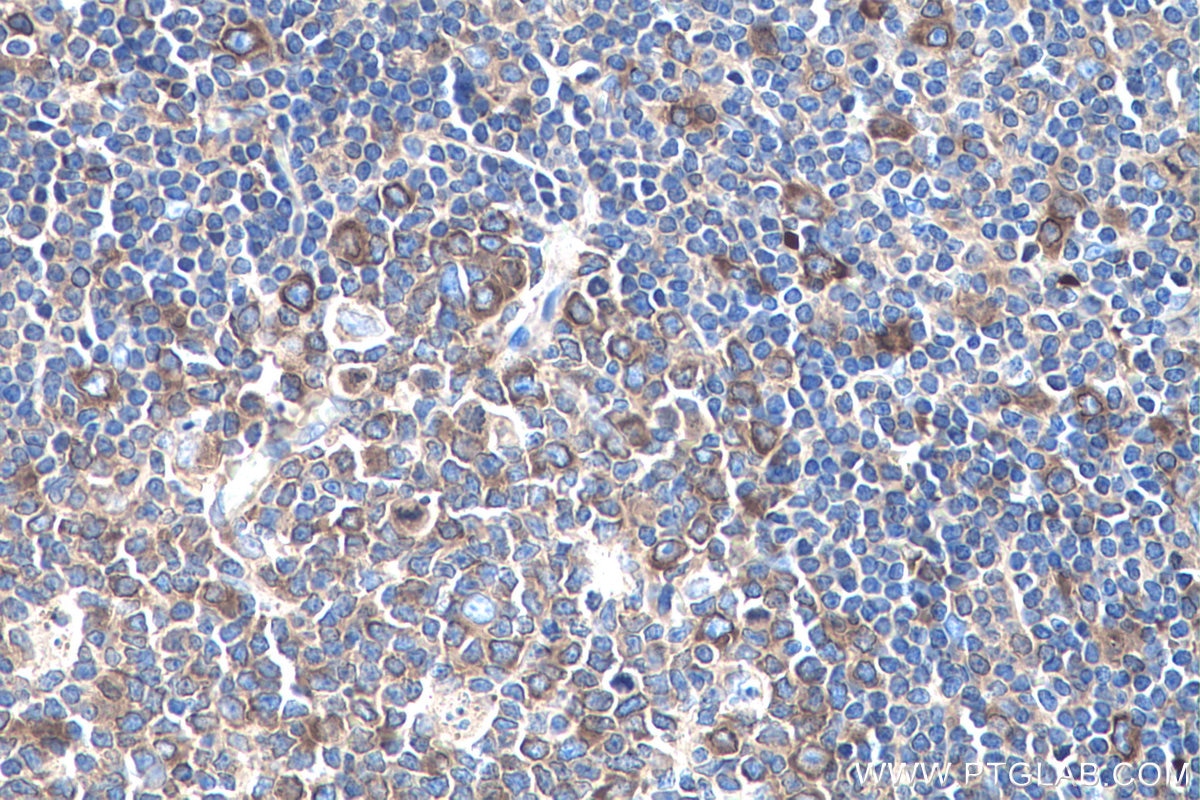 Immunohistochemistry (IHC) staining of human tonsillitis tissue using YBX1 Polyclonal antibody (20339-1-AP)