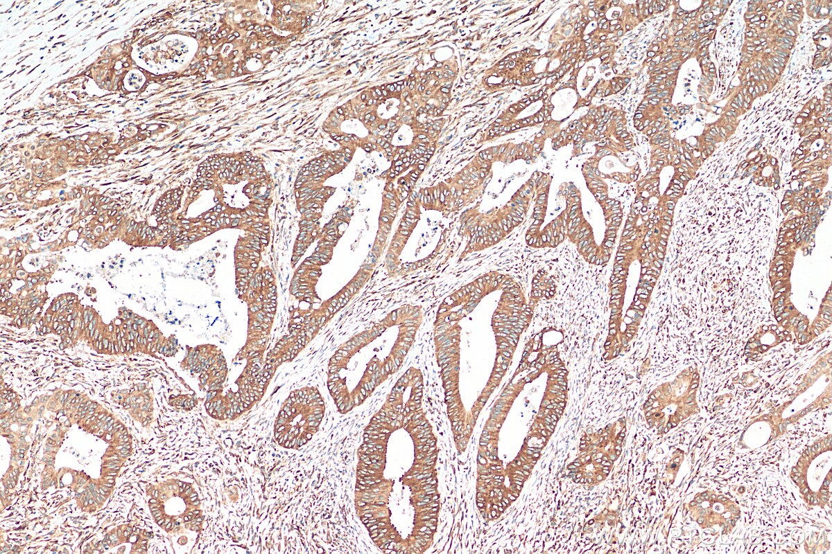 Immunohistochemistry (IHC) staining of human colon cancer tissue using YBX1 Polyclonal antibody (20339-1-AP)