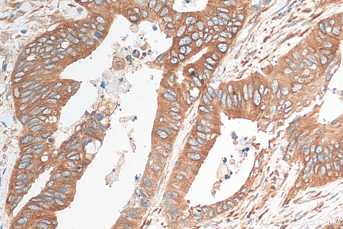 Immunohistochemistry (IHC) staining of human colon cancer tissue using YBX1 Polyclonal antibody (20339-1-AP)
