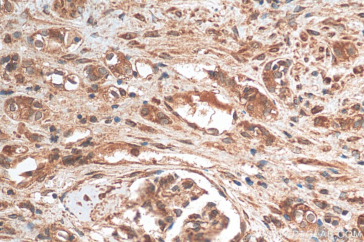 Immunohistochemistry (IHC) staining of human renal cell carcinoma tissue using YBX1 Polyclonal antibody (20339-1-AP)