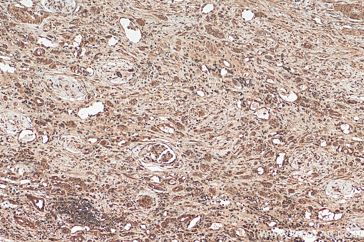 Immunohistochemistry (IHC) staining of human renal cell carcinoma tissue using YBX1 Polyclonal antibody (20339-1-AP)