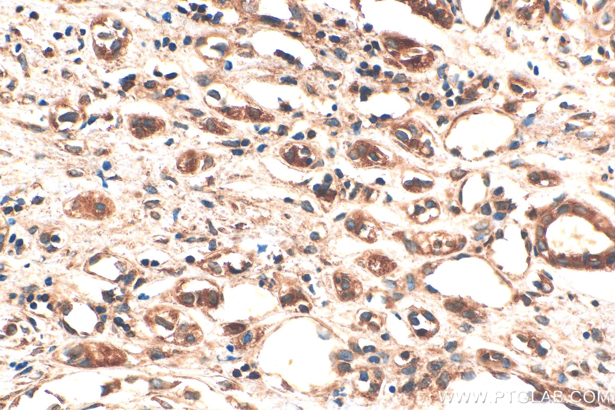 Immunohistochemistry (IHC) staining of human renal cell carcinoma tissue using YBX1 Polyclonal antibody (20339-1-AP)