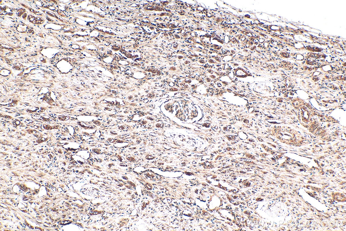 IHC staining of human renal cell carcinoma using 20339-1-AP