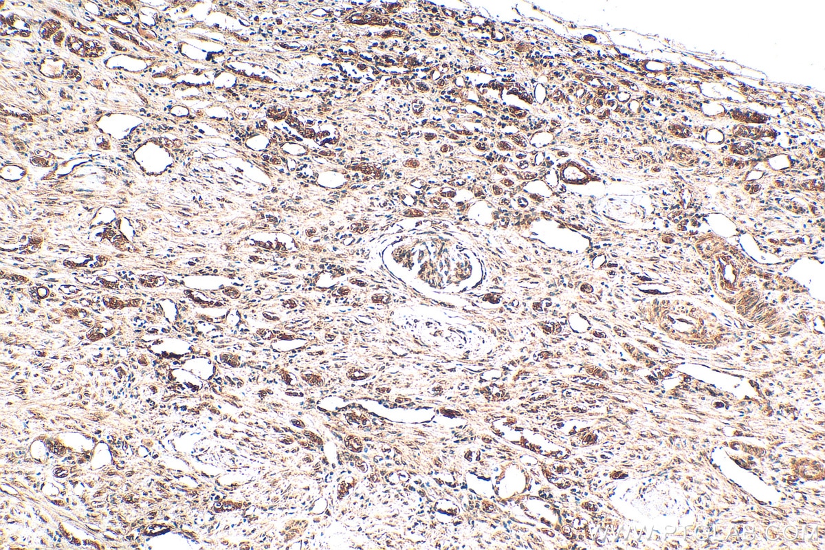 Immunohistochemistry (IHC) staining of human renal cell carcinoma tissue using YBX1 Polyclonal antibody (20339-1-AP)