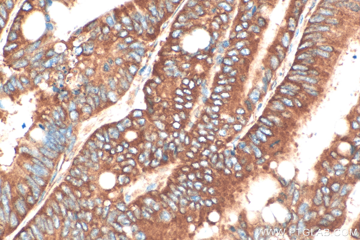 Immunohistochemistry (IHC) staining of human colon cancer tissue using YBX1 Polyclonal antibody (20339-1-AP)