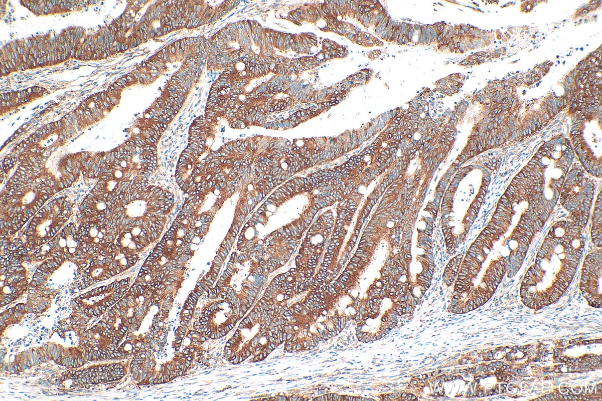 Immunohistochemistry (IHC) staining of human colon cancer tissue using YBX1 Polyclonal antibody (20339-1-AP)