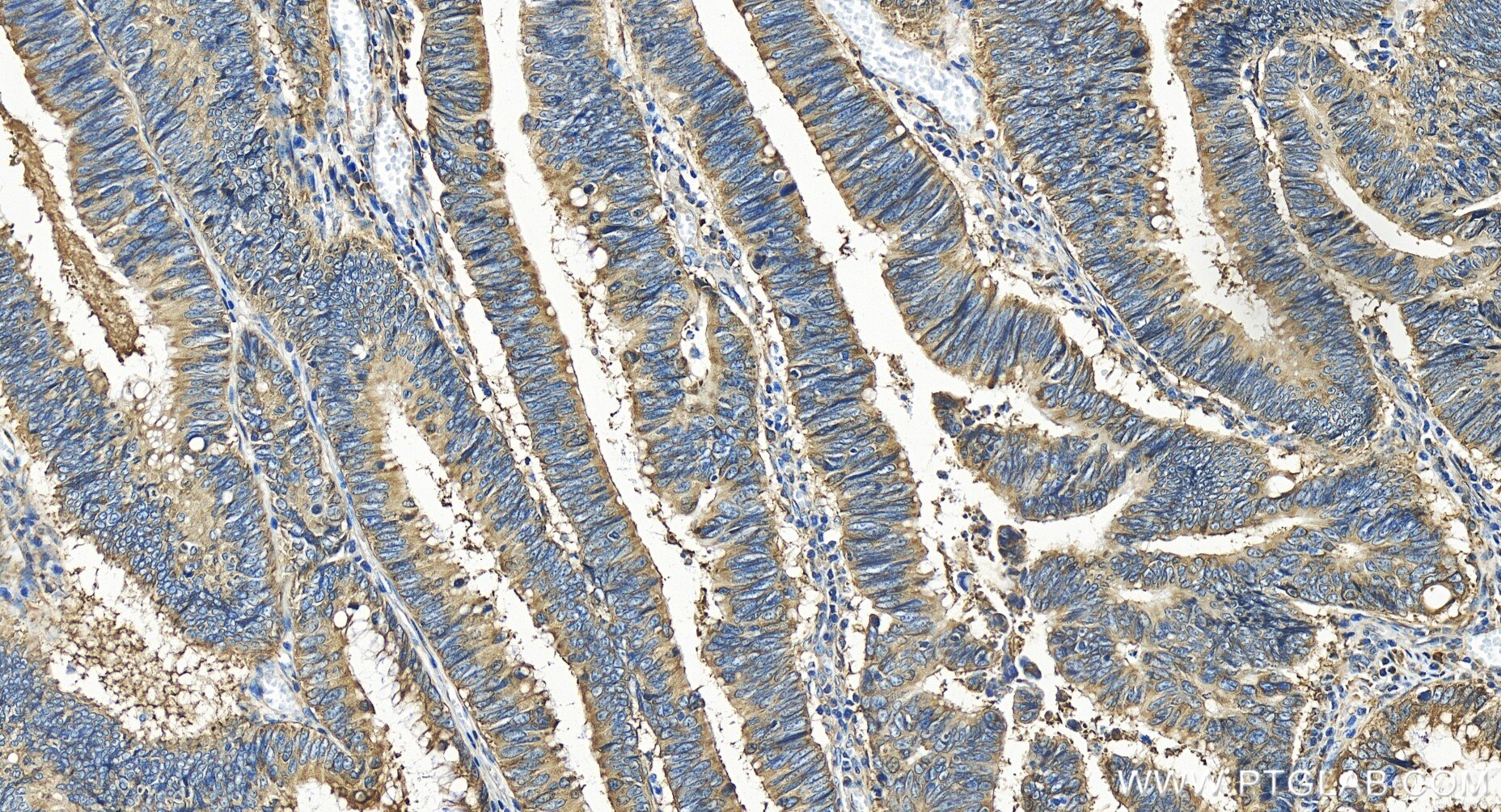 Immunohistochemistry (IHC) staining of human colon cancer tissue using YBX1 Recombinant antibody (84993-4-RR)