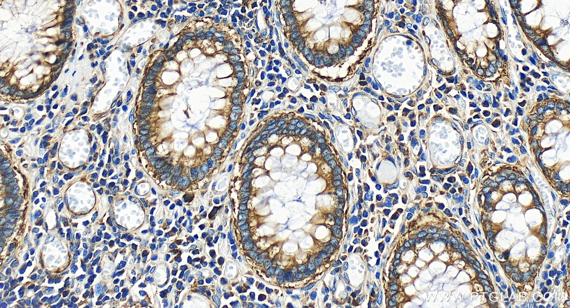 Immunohistochemistry (IHC) staining of human colon cancer tissue using YBX1 Recombinant antibody (84993-4-RR)