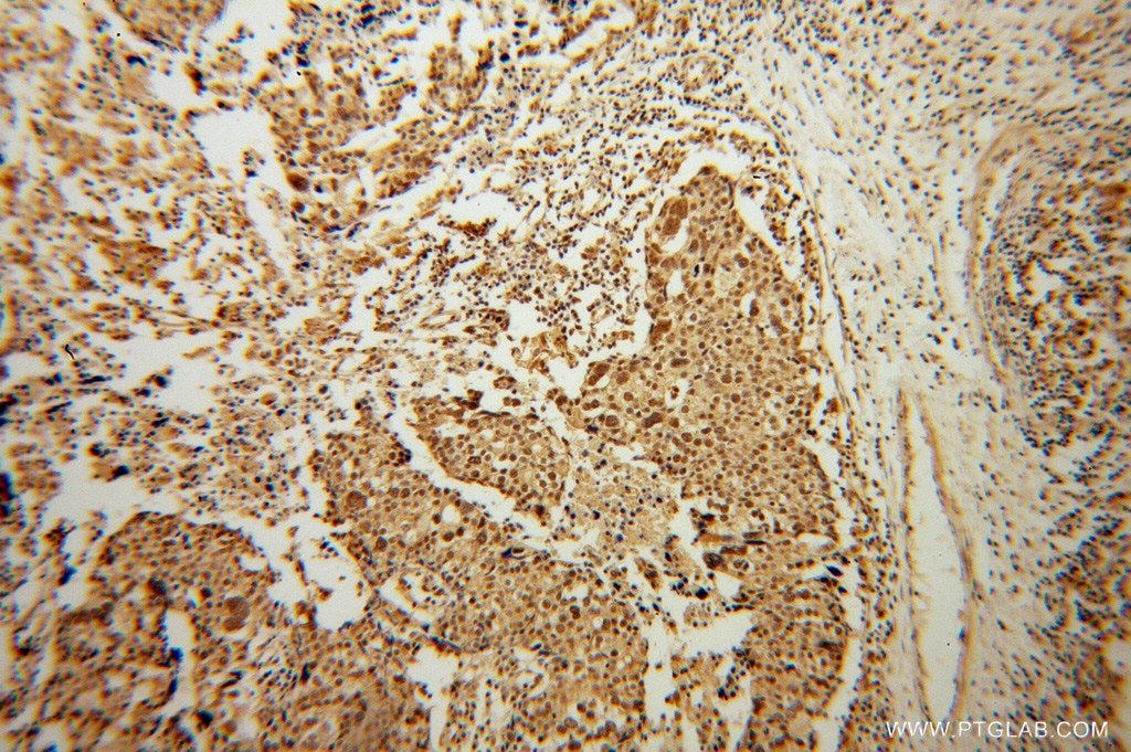 Immunohistochemistry (IHC) staining of human ovary tumor tissue using MSY2 Polyclonal antibody (13538-1-AP)
