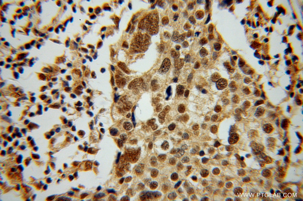 Immunohistochemistry (IHC) staining of human ovary tumor tissue using MSY2 Polyclonal antibody (13538-1-AP)