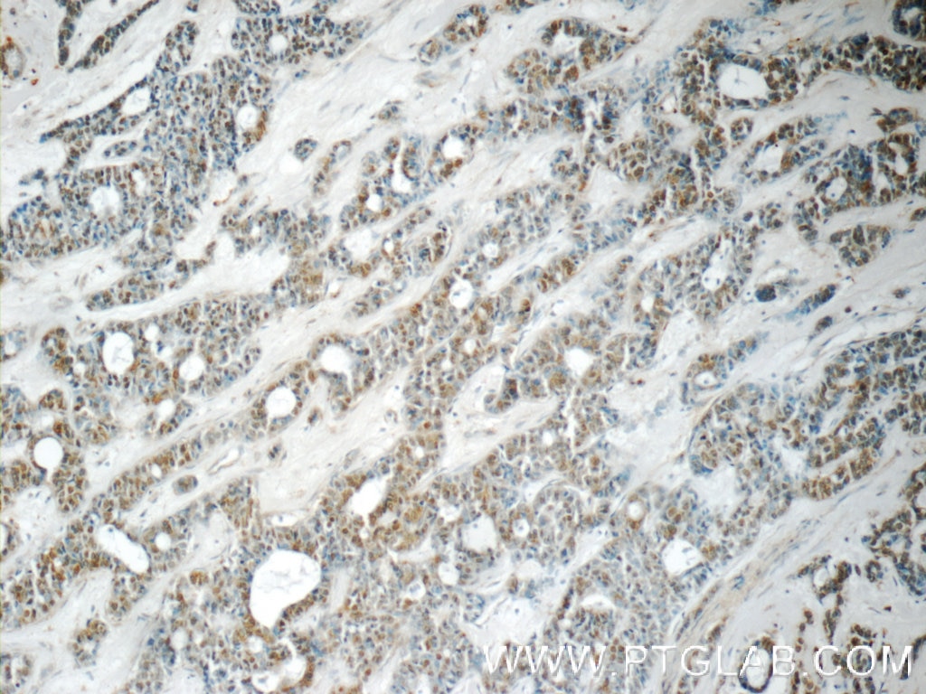 Immunohistochemistry (IHC) staining of human cervical cancer tissue using YEATS2 Polyclonal antibody (24717-1-AP)