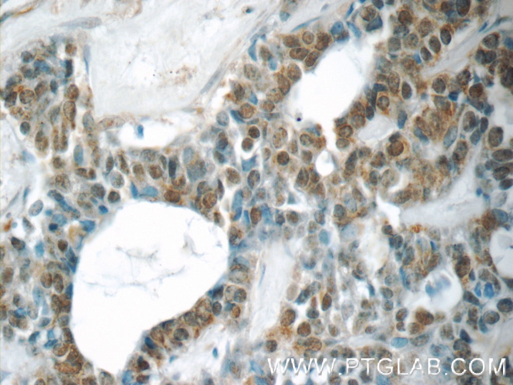 Immunohistochemistry (IHC) staining of human cervical cancer tissue using YEATS2 Polyclonal antibody (24717-1-AP)