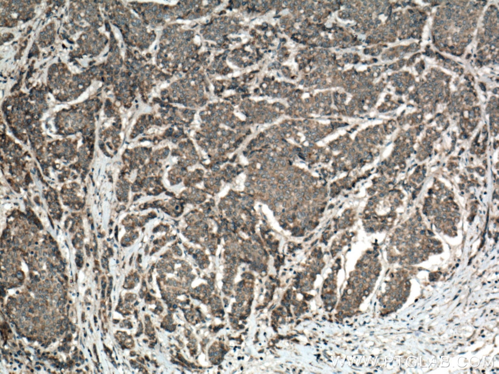 Immunohistochemistry (IHC) staining of human colon cancer tissue using YES1 Polyclonal antibody (13977-1-AP)