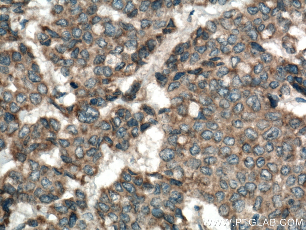 Immunohistochemistry (IHC) staining of human colon cancer tissue using YES1 Polyclonal antibody (13977-1-AP)