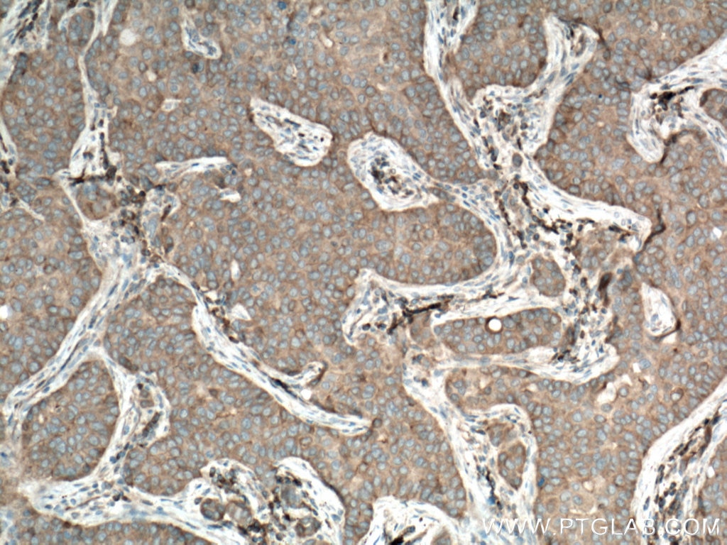 IHC staining of human breast cancer using 13977-1-AP